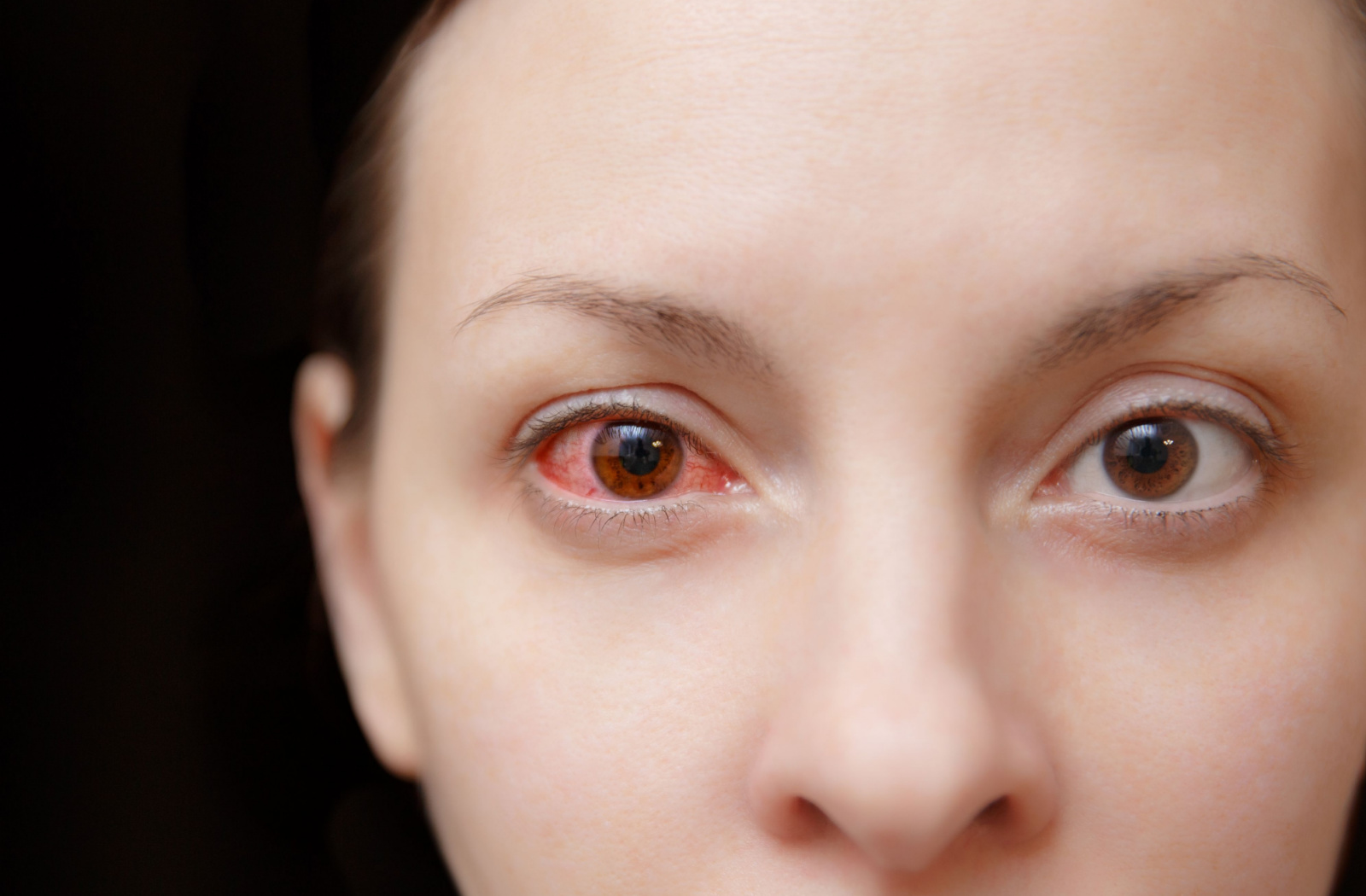 What Is Commonly Misdiagnosed As Pink Eye Minneapolis