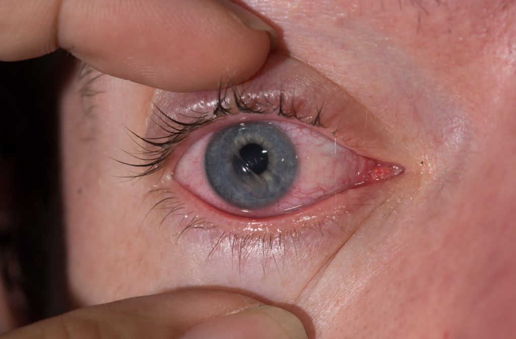 Close up of eye that has cornea scratch