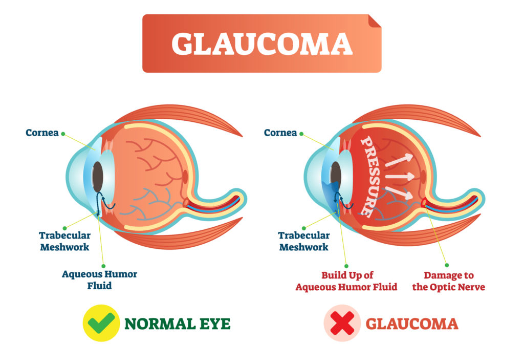 Illustration of normal eye on the left and eye with glaucoma on the right.