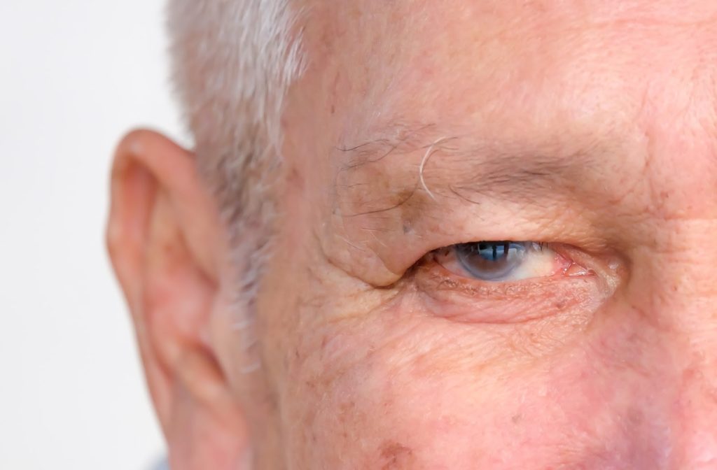 Close up of older gentleman with glaucoma in his right eye