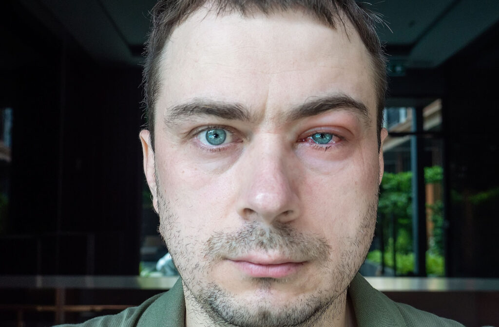 A close-up of a man with signs of Blepharitis on his left eye.
