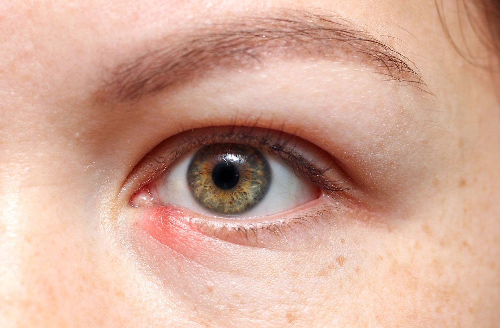 Can You Wear Contacts With a Stye? | Minneapolis